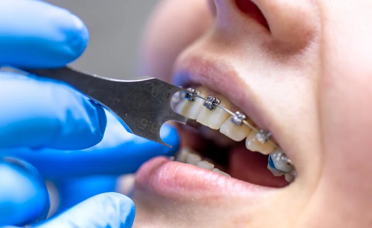 Uno de los mejores ortodoncistas en España poniéndole brackets a su cliente